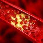 این علائم به شما می‌گوید چربی خون دارید